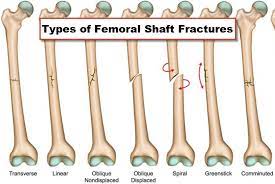 fem shaft fractures