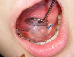 ectopic tonsillar tissue