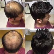 It really depends on how the weave is installed. Classic Hair Weaving Centre Hair Loss Doctors Book Appointment Online Hair Loss Doctors In Hoshiarpur Ho Hoshiarpur Justdial