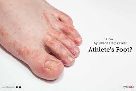 how ayurveda helps treat athlete s foot