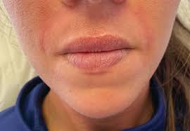 how long do lip fillers last how to
