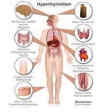 thyroid disease 20 symptoms the