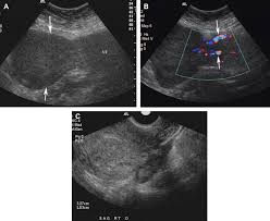sonography of the uterine myometrium