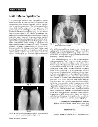 pdf nail patella syndrome