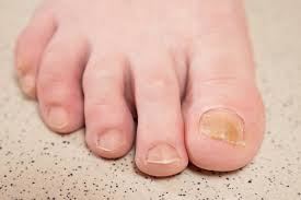 yellow toenails symptoms causes and