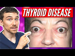 thyroid eye disease and graves disease