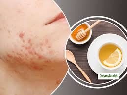 acne and pimples facts to know before