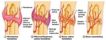 fracture healing basic science