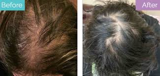 minoxidil for hair loss how it works
