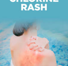 chlorine rash symptoms causes