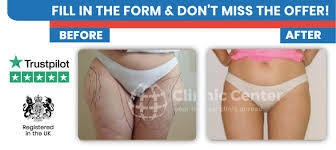 How much is chin lipo uk. Liposuction In Turkey Cost Fat Removal Surgery Best Lipo Surgeons
