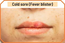 blister on lip cold sores and 13 other