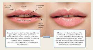 type of lip fillers your complete