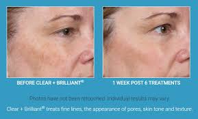 skin resurfacing treatments for large