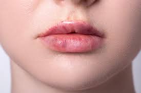 bruising after lip filler causes and