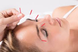 Acupuncture for Headache Relief - Endpoint Wellness - Medium
