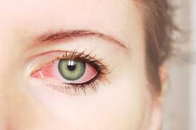 itchy red eyes are signs of an allergy