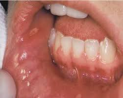 what causes mouth ulcers everything