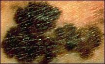 What does scalp melanoma look like? What Does Melanoma Look Like National Cancer Institute