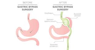 gastric byp surgery
