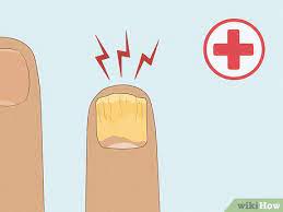 how to cure nail fungus home remes