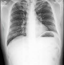 Zwapnienie płuc - czy to groźna dolegliwość? Kiedy się pojawia i czy da się  ją leczyć?