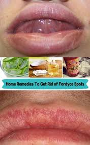 lip balm and fordyce spots