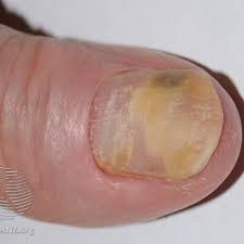causes of a loose toenail or fingernail