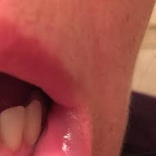 swelling behind lip inside mouth