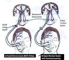 a nerve lesion bell s palsy b