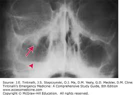 orbital out fractures core em