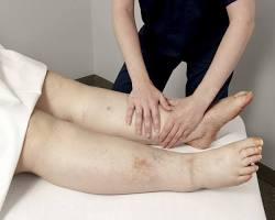 Image of Physiotherapy for Lymphedema