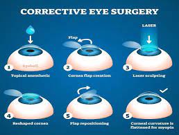 what is lasik surgery know its cost