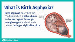 Are Birth Asphyxia and Moro Reflex ...