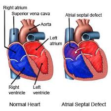 The hole separating the upper chambers of the heart is known as an atrial septal defect (asd), and the opening in the lower part is a ventricular septal signs and symptoms of a hole in the heart. Atrial Septal Defect What You Need To Know
