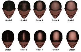 male androgenetic alopecia endotext
