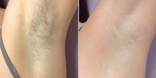 It generally takes 4 to 6 sessions to achieve results. Laser Hair Removal Kuala Lumpur Malaysia Cost Reviews Benefits Nexus Cllinic