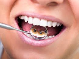 People who are new to braces are often surprised by how painful the procedure there isn't really 1 solution to stop braces hurting or to get rid of brace pain entirely. Lingual Braces Pros And Cons Cost Comfort Lisping And More