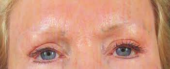 permanent makeup removal in nyc and