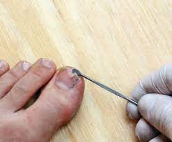 your toenail is falling off