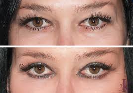 eyelid surgery blepharoplasty in