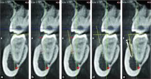 Tomographic mapping of buccal shelf area for optimum placement of bone  screws: A three-dimensional cone-beam computed tomography evaluation - APOS  Trends in Orthodontics