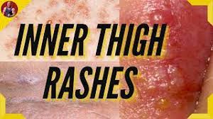 how to treat inner thigh rash and
