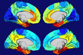 study yields clues to why alzheimer s