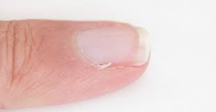 common nail diseases disorders