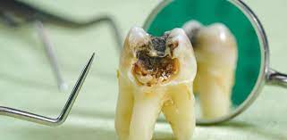 why do rotten teeth cause bad breath