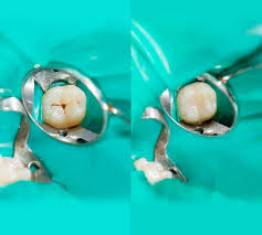 Dental Fissure Sealants - Moggill Dental