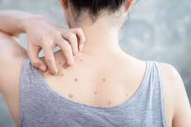 back acne bacne causes treatment