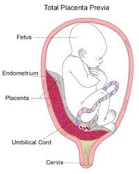You may have different outcomes depending on the type of placenta previa you have. Causes Of Bleeding In Pregnancy Placenta Previa Placental Abruption Children S Wisconsin