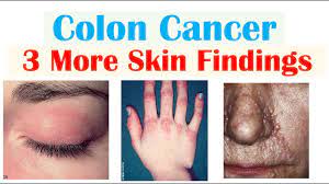 colon cancer 3 other weird symptoms